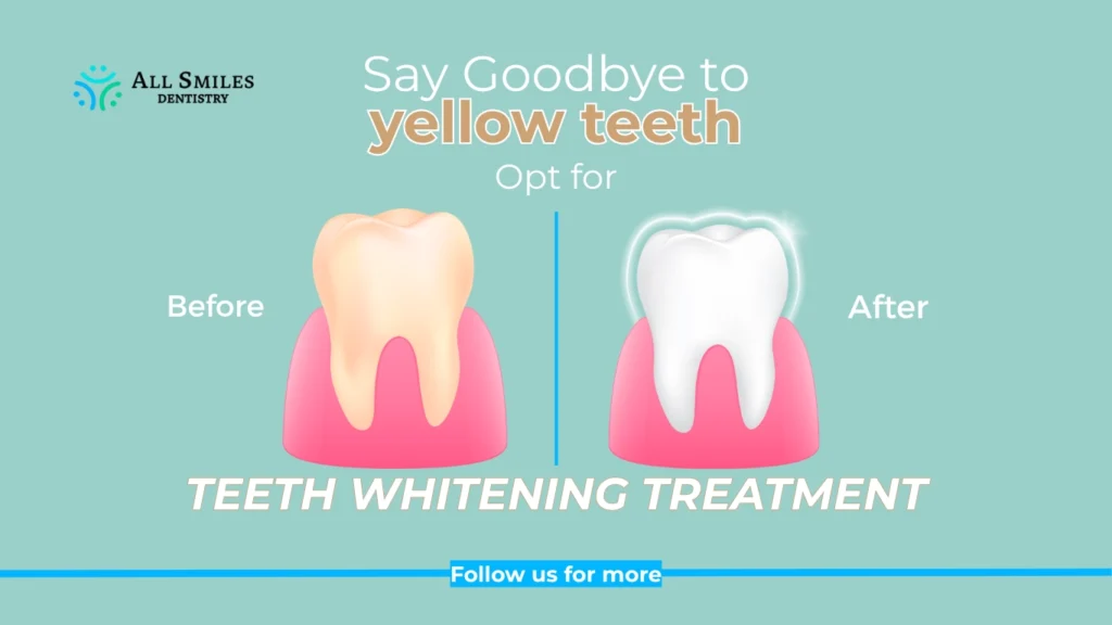 Say Goodbye to Yellow Teeth